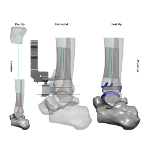 Total Ankle Replacement