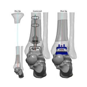 Total Ankle Replacement - General